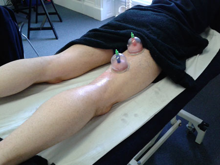 Physio-Suckers